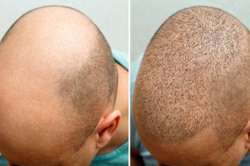 Hair Transplant