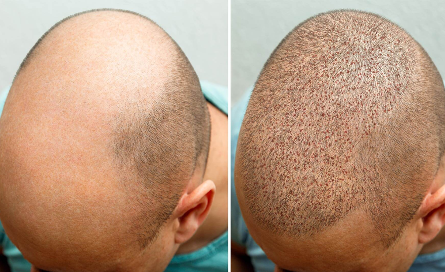 Hair Transplant